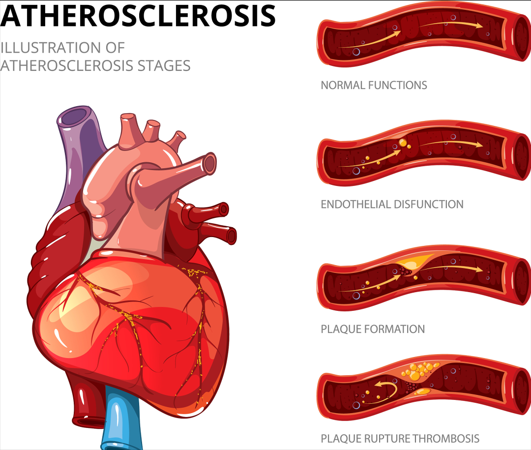 2药强效持久降脂，相比“他汀”生物利用度更高，副作用更小，不反弹