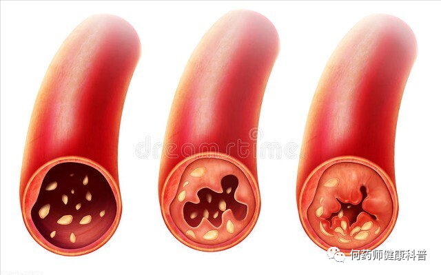 长期吃降血脂药，伤肝伤肾？什么时候吃最好？注意5点更安全有效