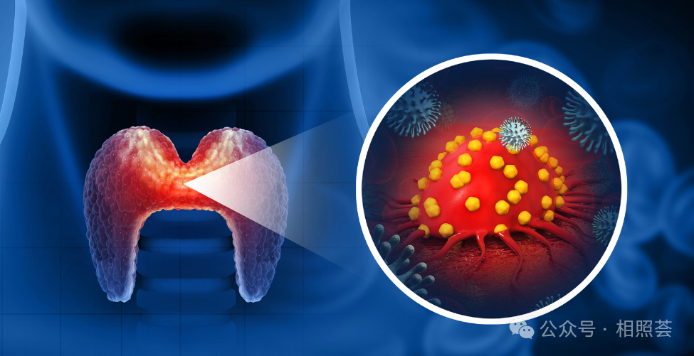 甲状腺癌微创革命：射频消融术取代开放手术，疤痕仅1mm！