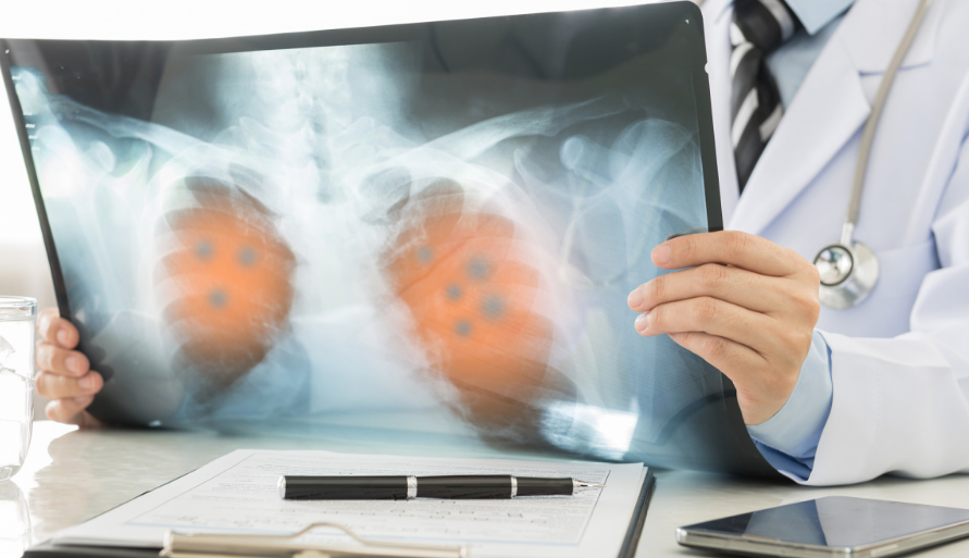 抗癌新突破：NICE-TIL疗法为实体瘤患者带来新生机！