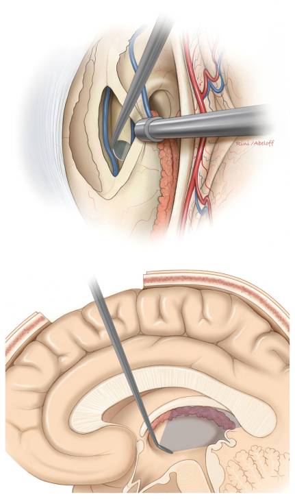 经胼胝体穹窿间入路手术策略与技巧theneurosurgicalatlas全文翻译