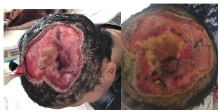 丽江一例被熊咬伤的病患成功救治丨颅脑创伤神经重症病例周刊第46期