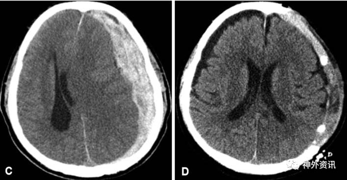 急性硬脑膜下血肿选择什么手术好