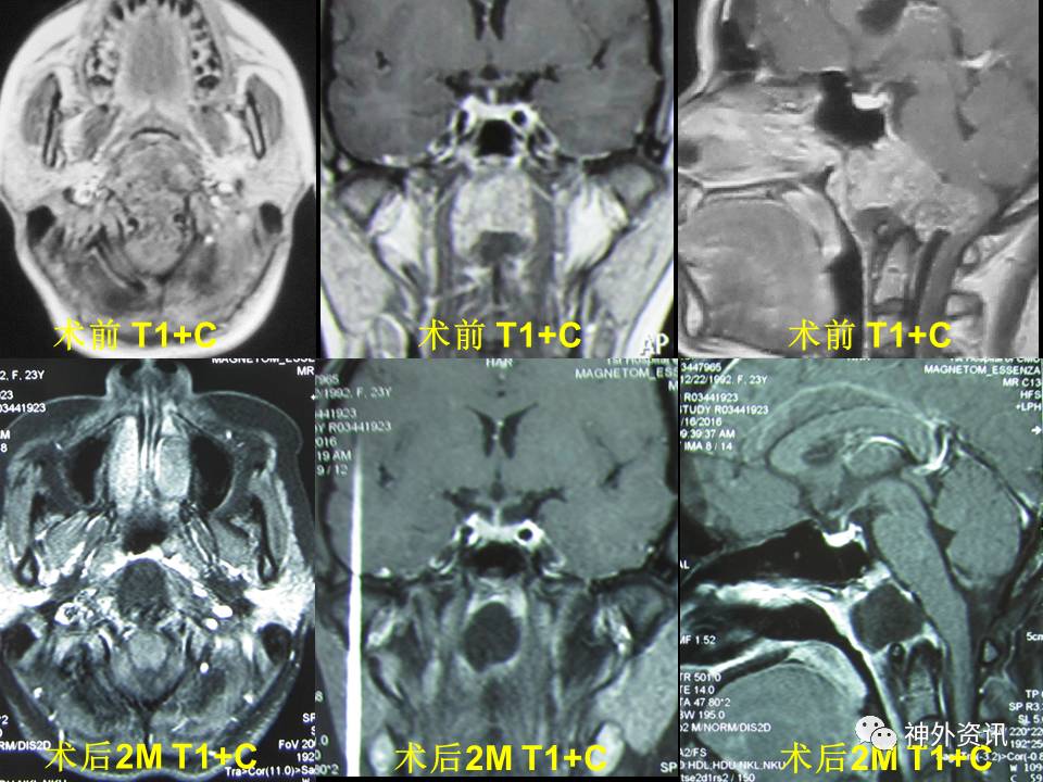 王义宝教授下斜坡颅底内外沟通性脊索瘤的内镜经鼻一期手术治疗