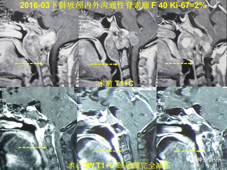 王义宝教授下斜坡颅底内外沟通性脊索瘤的内镜经鼻一期手术治疗