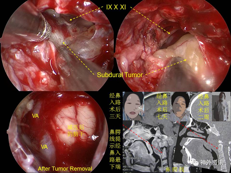 王義寶教授下斜坡顱底內外溝通性脊索瘤的內鏡經鼻一期手術治療