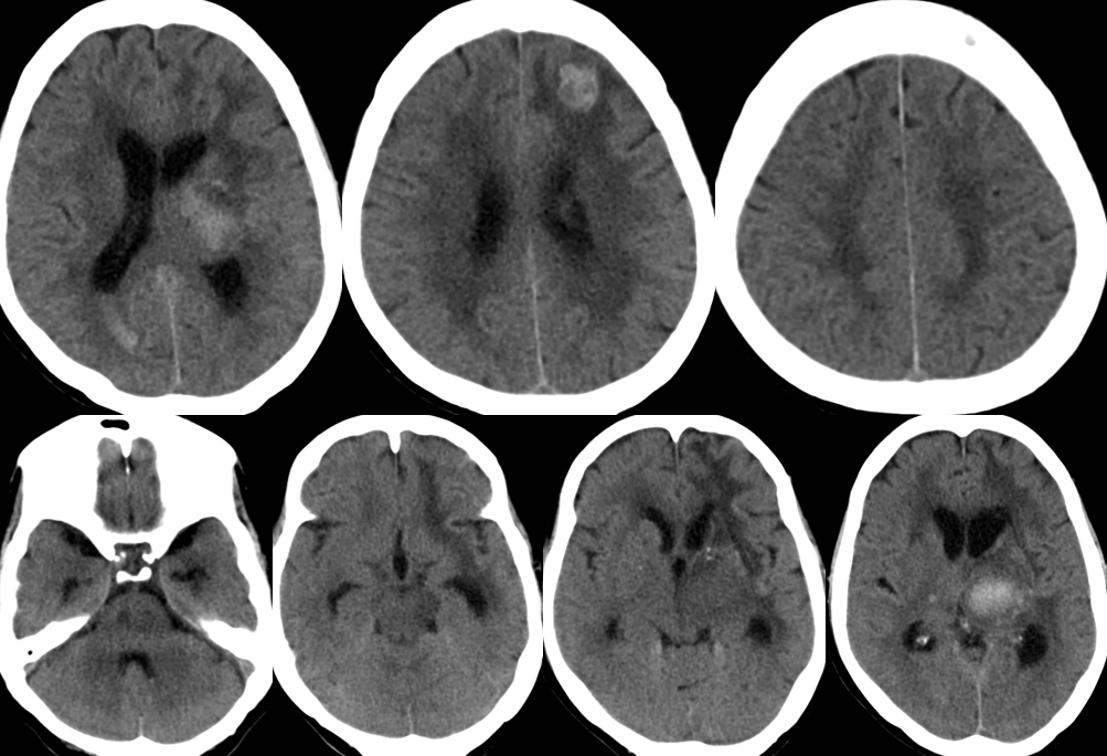 脑出血术后神经重症处理_医学界-助力医生临床决策和职业成长