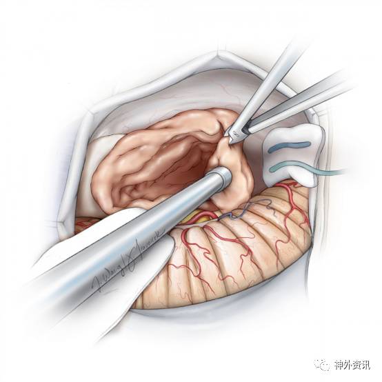 乙狀竇後入路切除聽神經瘤手術策略與技巧丨theneurosurgicalatlas