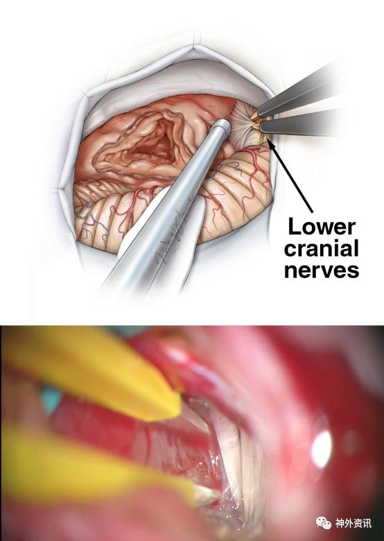 听神经瘤手术示意图图片