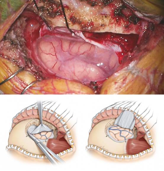 眶上开颅术手术策略与技巧丨theneurosurgicalatlas系列