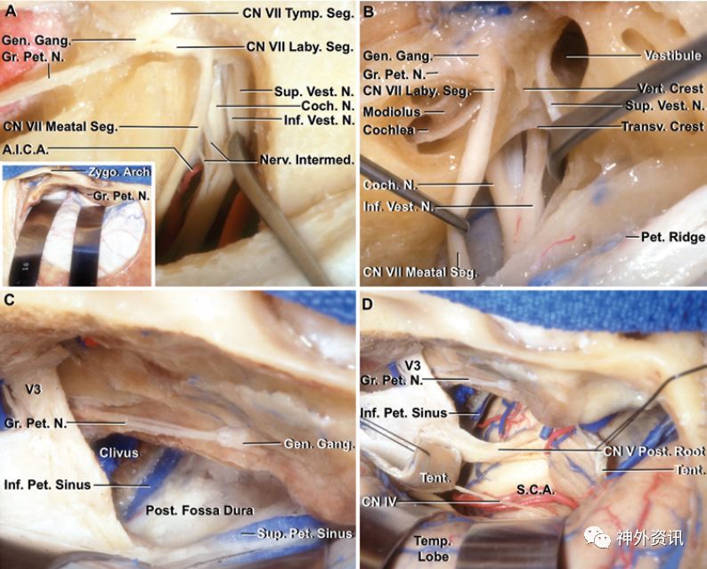 硬膜外结构和gpn,磨除内听道顶部,打开硬膜暴露内听道内部神经结构;b.
