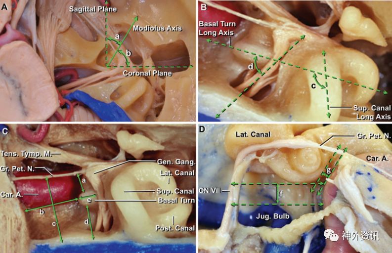 岩嵴上缘和中颅窝底是三叉神经和蜗管压迹,三叉隆起及弓状隆
