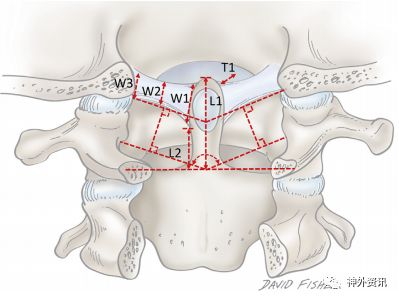 翼状韧带的解剖一形态特征和变异