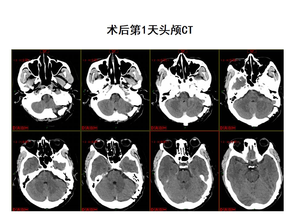钟东教授团队术后保留听力的小型囊实性听神经瘤1例