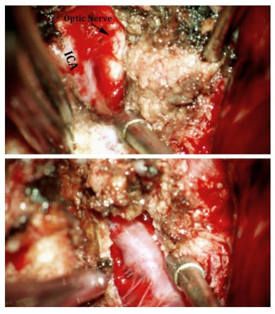 蝶骨嵴內側型腦膜瘤手術技巧丨theneurosurgicalatlas全文翻譯