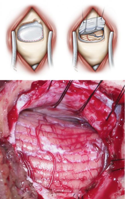 旁正中小脑上入路开颅手术策略与技巧丨theneurosurgicalatlas全文