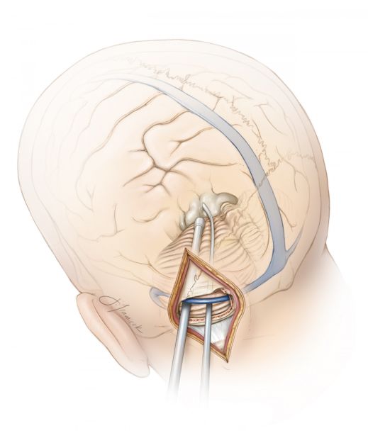 旁正中小脑上入路开颅手术策略与技巧丨theneurosurgicalatlas全文