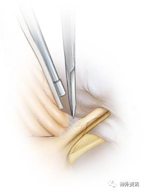 图13. 采用显微剪刀来锐性分离vii/viii与小脑/绒球之间的蛛网膜.