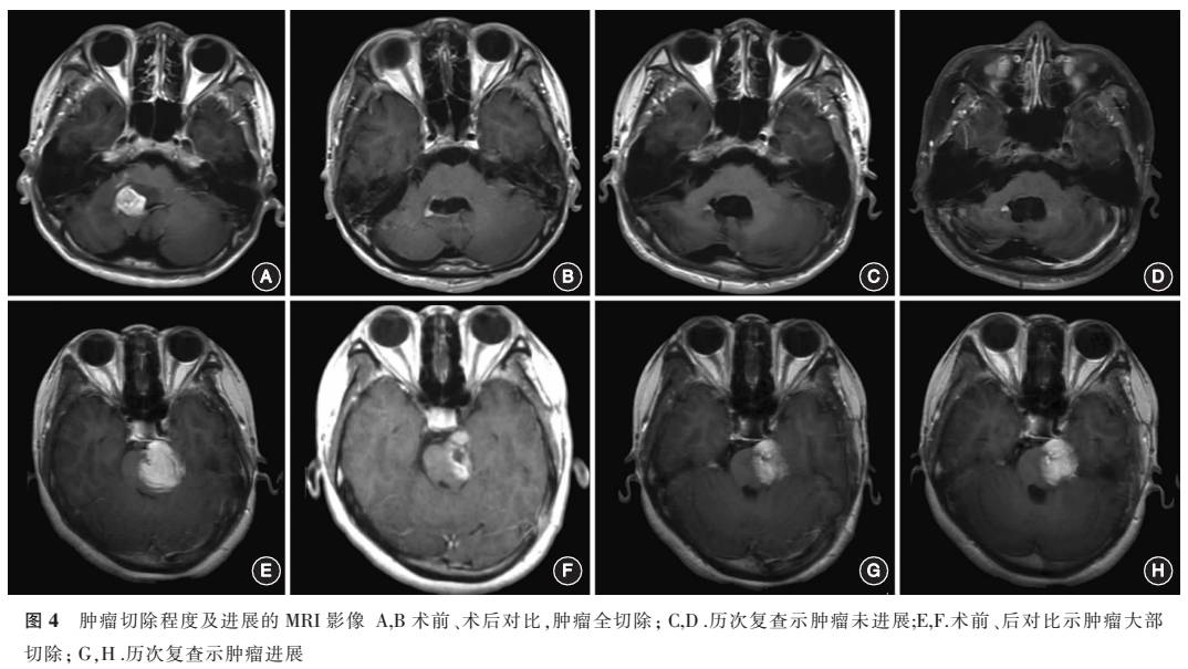 脑干神经节细胞胶质瘤的临床特征及外科治疗丨中华神外2017年第五期