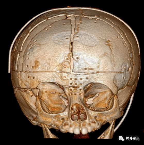 nexus手术技巧丨第二十五期额眶前移术治疗单侧冠状缝颅缝早闭