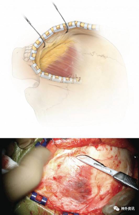 眶顴入路手術策略與操作技巧theneurosurgicalatlas全文翻譯