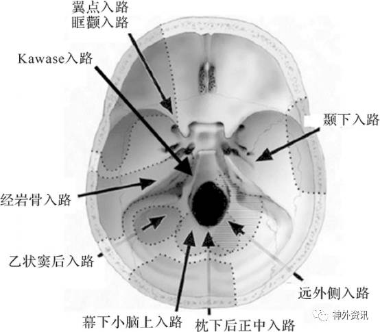 神經內鏡下經鼻蝶斜坡入路切除腦幹海綿狀血管瘤一例浙二神外週刊第77