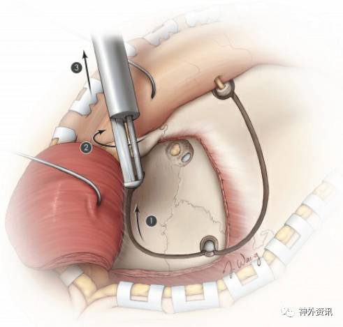 图23:继续用带底座的铣刀进行下部开颅.