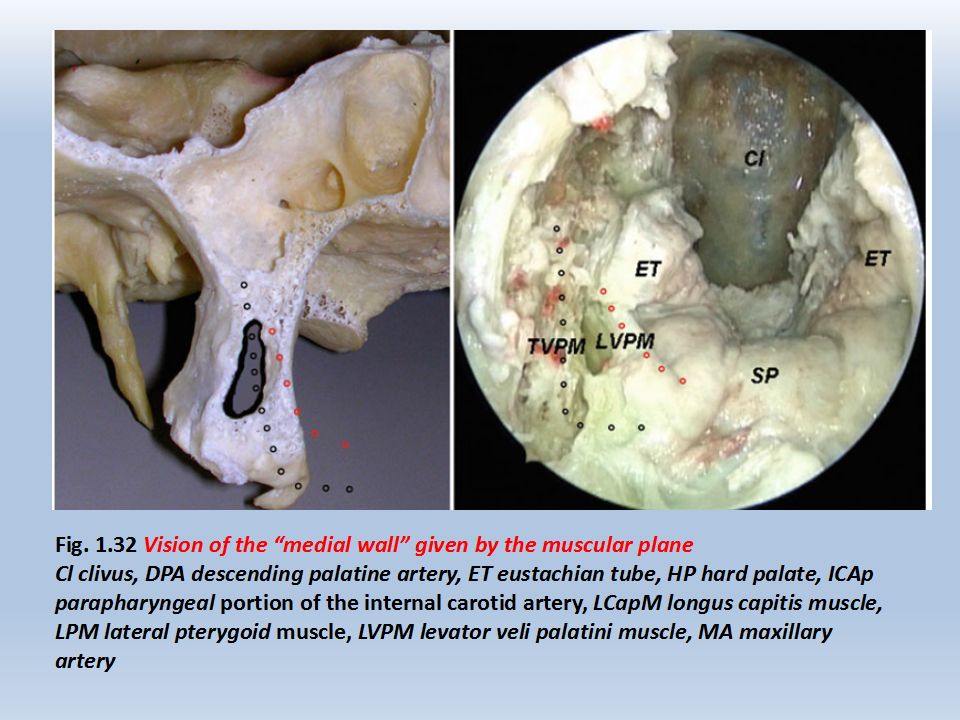 耳後經顳入路(postauricular transtemporal approach)耳後c切口