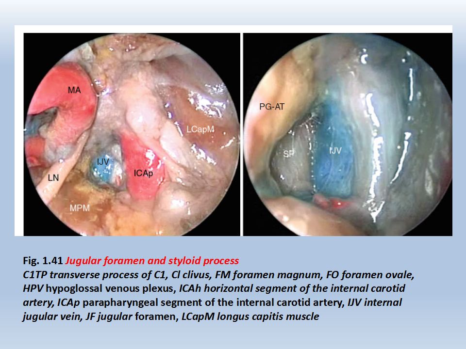 rhoton教授在其jugular foramen章节,曾对颈静脉孔区手术入路进行非常