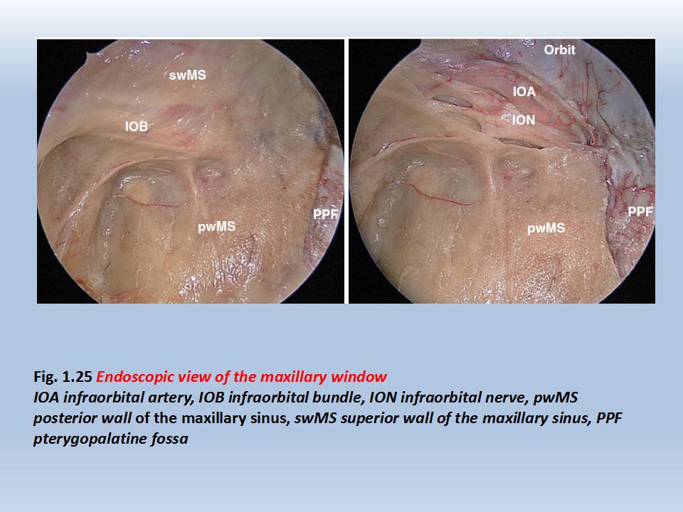 耳後經顳入路(postauricular transtemporal approach)耳後c切口