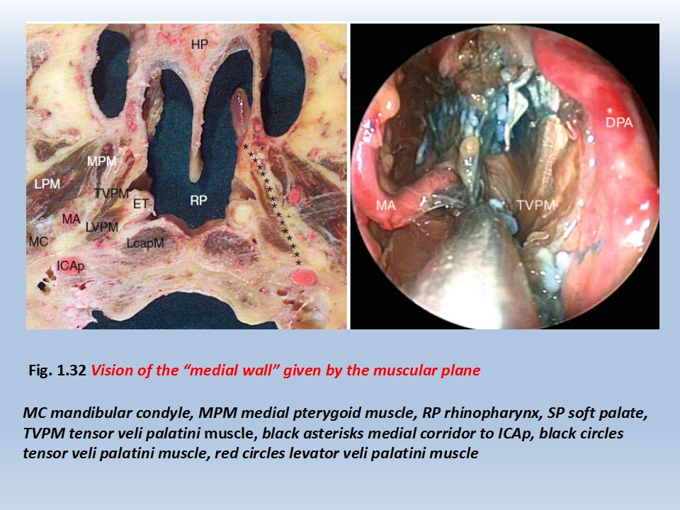 rhoton教授在其jugular foramen章节,曾对颈静脉孔区手术入路进行非常