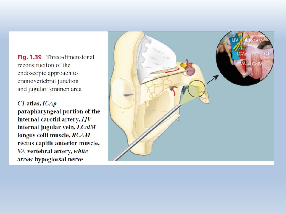 神经外科手术入路八颈静脉孔区