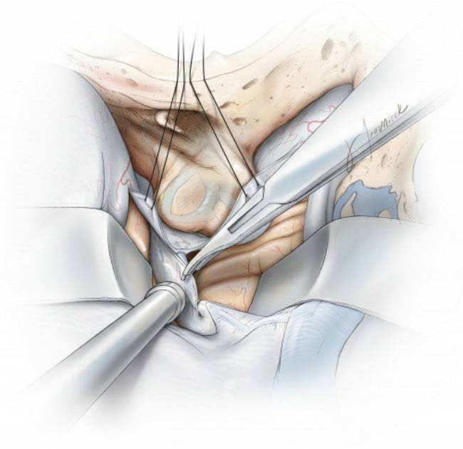 擴大經巖骨後入路手術技巧丨theneurosurgicalatlas全文翻譯