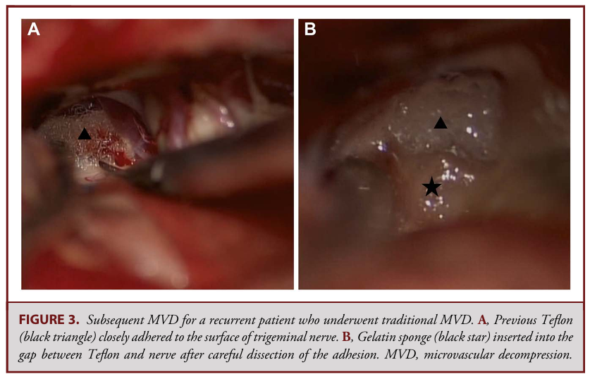 明胶在血管怎么降解【中国声音】明胶海绵置入在微血管减压术治疗三叉神经痛的应用：一项回顾性队列研究_https://www.jmylbn.com_新闻资讯_第12张