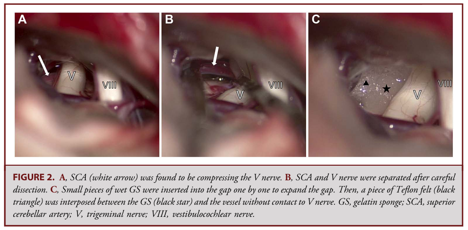 明胶在血管怎么降解【中国声音】明胶海绵置入在微血管减压术治疗三叉神经痛的应用：一项回顾性队列研究_https://www.jmylbn.com_新闻资讯_第11张