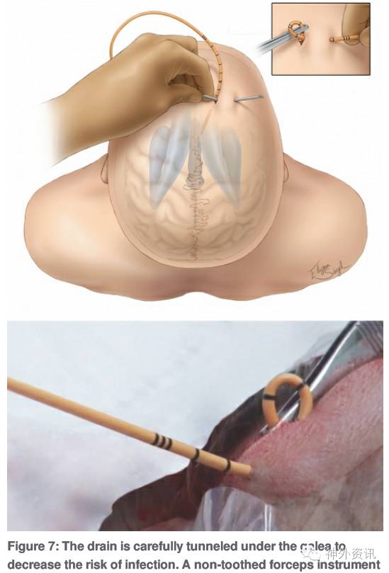 脑室外引流的操作技巧theneurosurgicalatlas系列