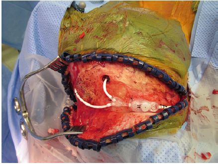 双侧脑室腹腔分流术对特发性颅高压更有效