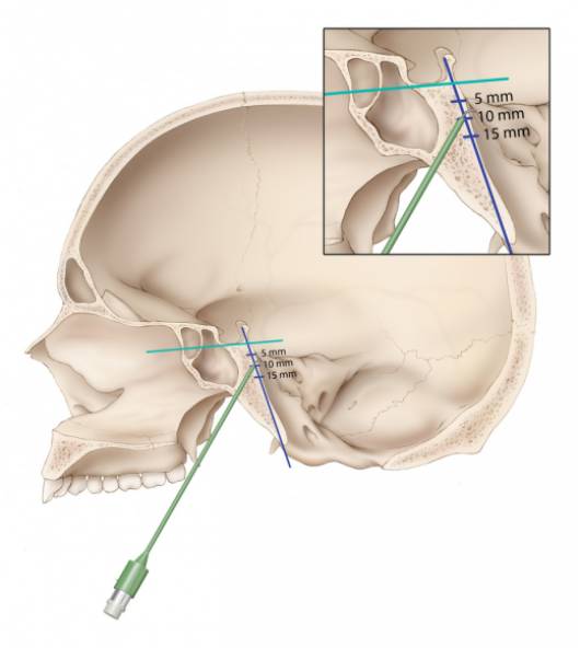 卵圆孔的定位与穿刺丨the neurosurgical atlas全文翻译