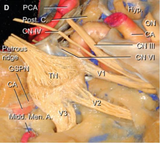注意卵圆孔(箭头)与翼突外侧板和下颌窝的位置关系.