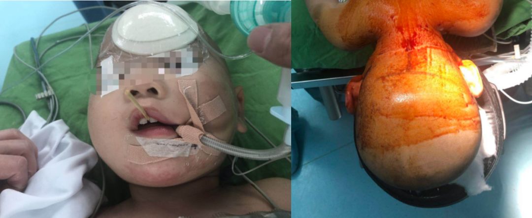 儿童意外脑干穿刺伤一例小儿神经外科系列五浙二神外周刊第195期