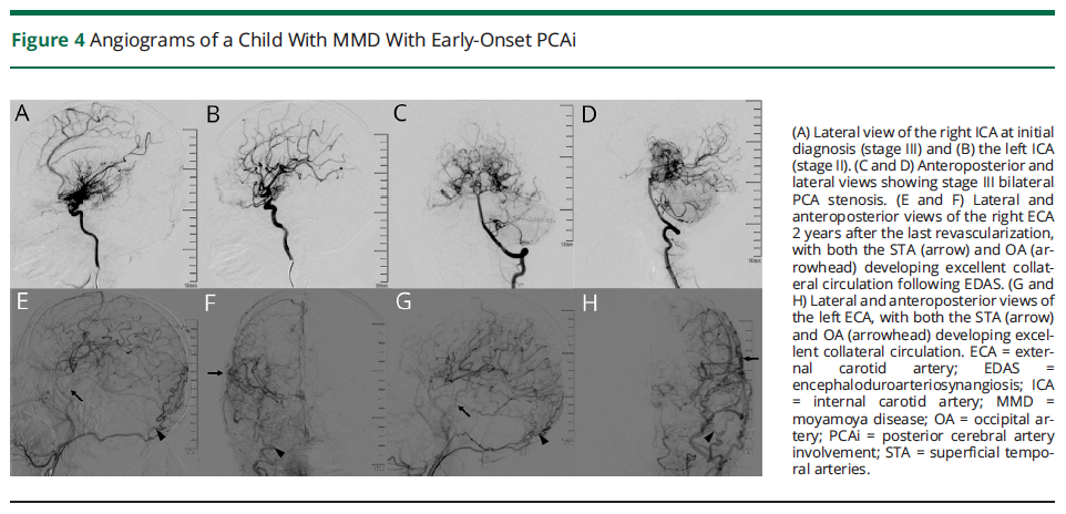 mmd在医学上什么意思【中国声音】段炼／韩聪教授团队：新证据揭示儿童烟雾病合并后循环病变的有效治疗方案_https://www.jmylbn.com_新闻资讯_第10张