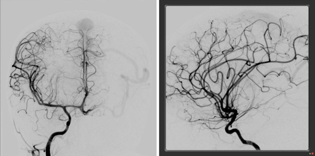 动脉顶枕支,左侧大脑后动脉距状裂支上矢状窦瘘(软脑膜动静脉瘘)(图3)