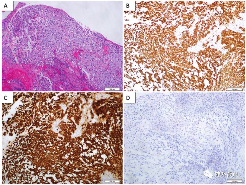 图3. 斜坡脊索瘤病理学检查结果.a.