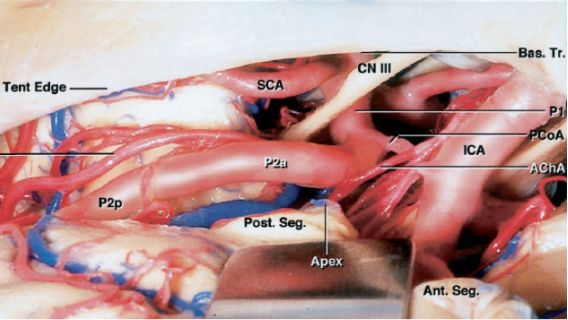 基底動脈動脈瘤顳下入路的手術策略與技巧theneurosurgicalatlas全文