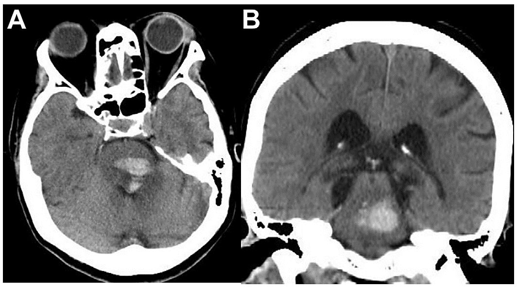 图1 ct显示左侧桥脑出血图2 术中发现:a