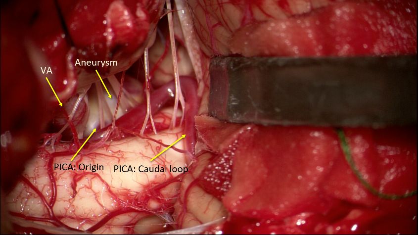 朱巍教授複合手術左側椎動脈夾層動脈瘤孤立及枕動脈小腦後下動脈端側