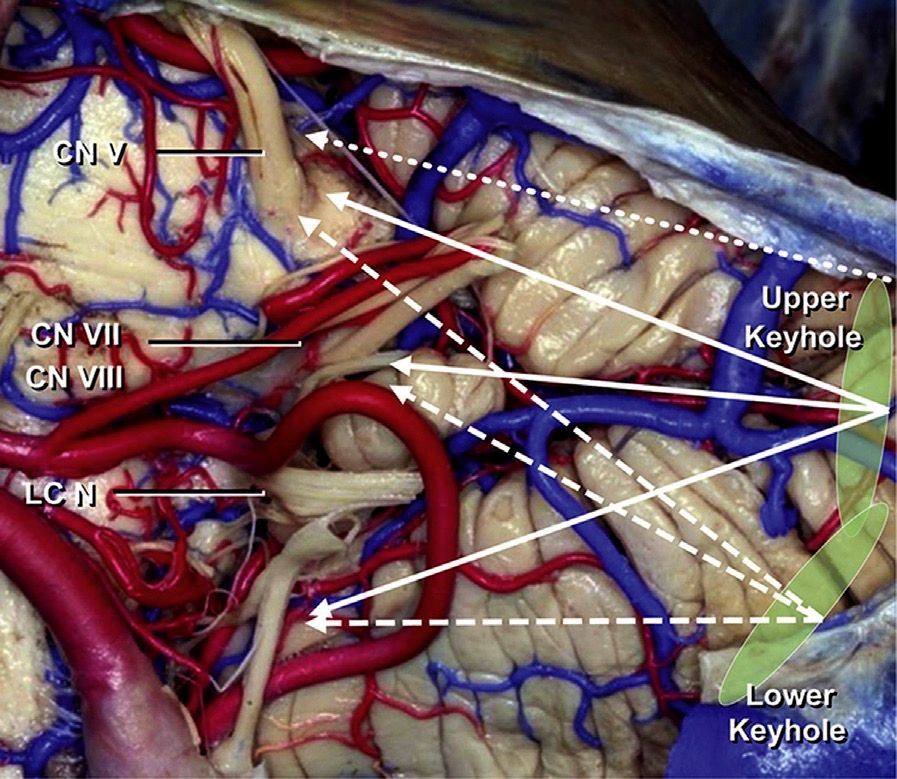 包映晖教授内镜下经乙状窦后入路微血管减压术病例回顾emvd