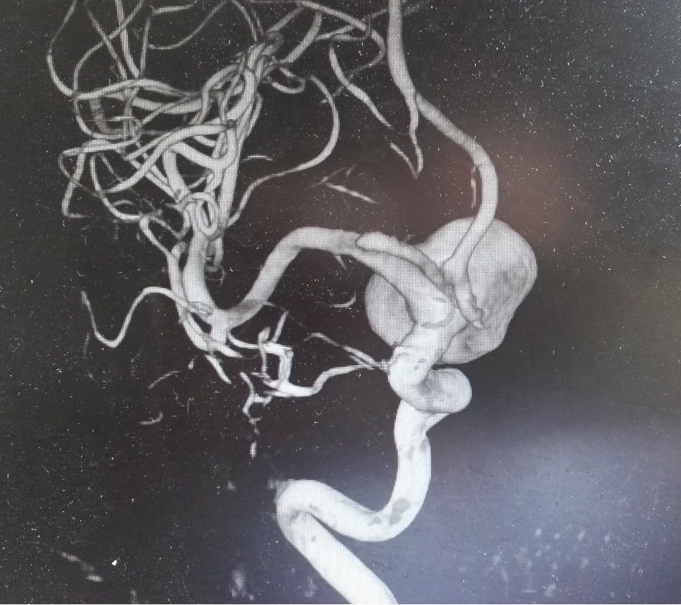 周国胜副教授术中穿刺瘤体减压显微手术夹闭颈内动脉后交通巨大动脉瘤