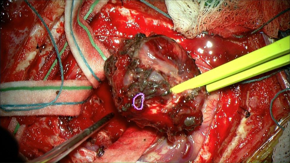 nexus手术技巧丨第二十三期经额入路脑动静脉畸形切除术