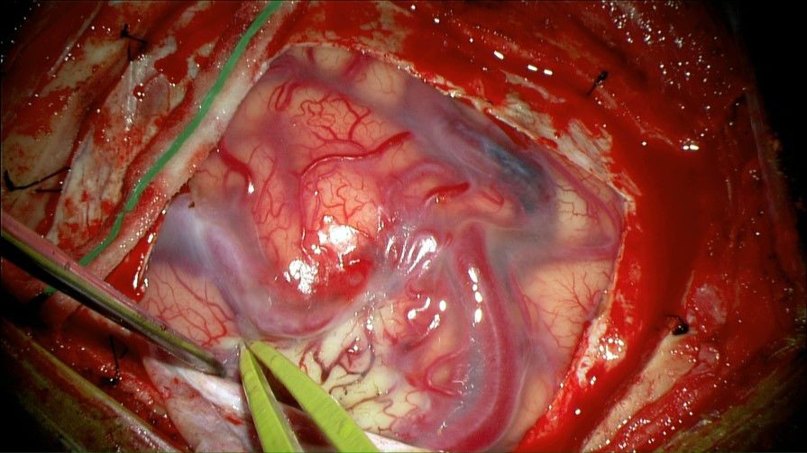 nexus手术技巧丨第二十三期经额入路脑动静脉畸形切除术